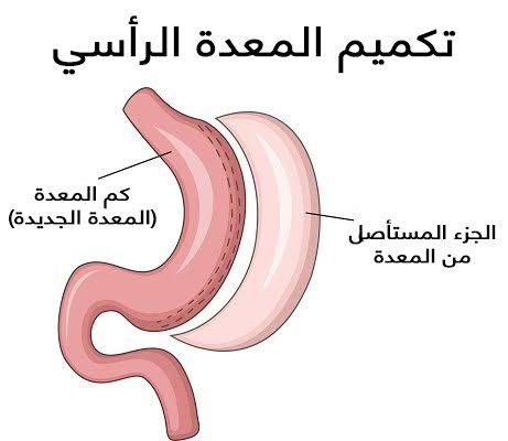 تكميم المعدة في دبي