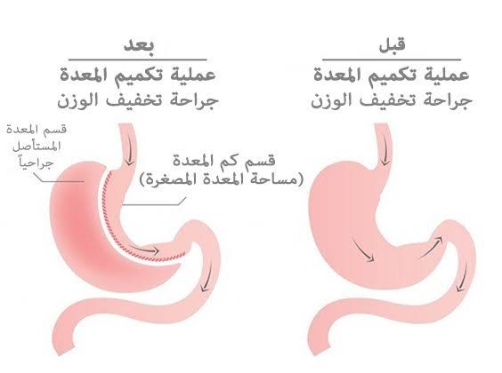 قص المعدة في دبي