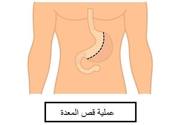 تكميم المعدة في دبي